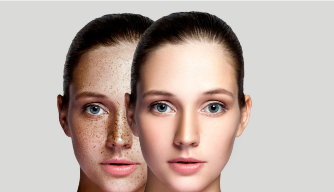 What Causes Skin Hyperpigmentation & Dark Spots ?