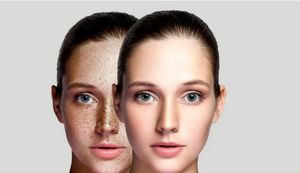 What Causes Skin Hyperpigmentation & Dark Spots ?