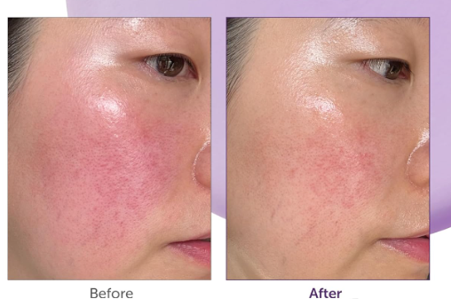 5 Gentle Steps to Soothe Rosacea-Prone Skin